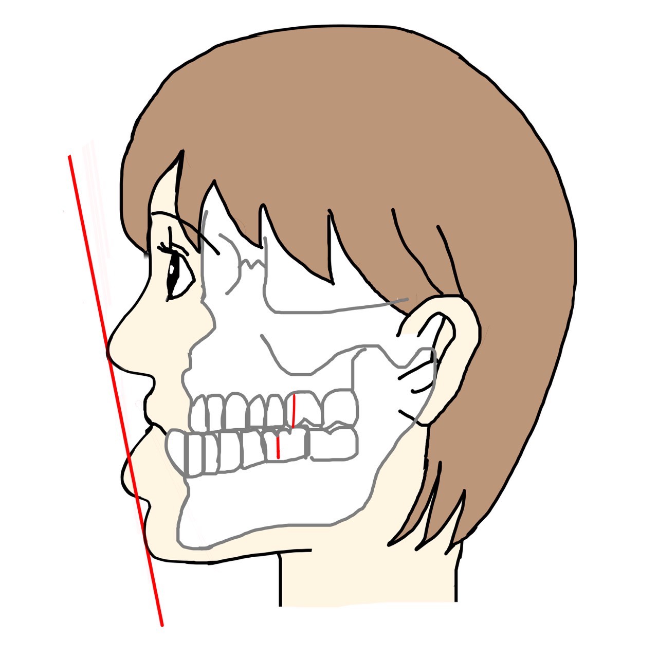 受け口のイラスト